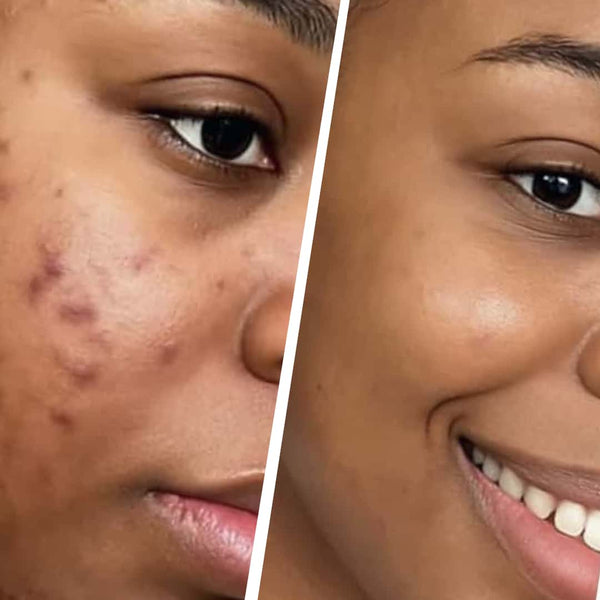 Réduit boutons & imperfections